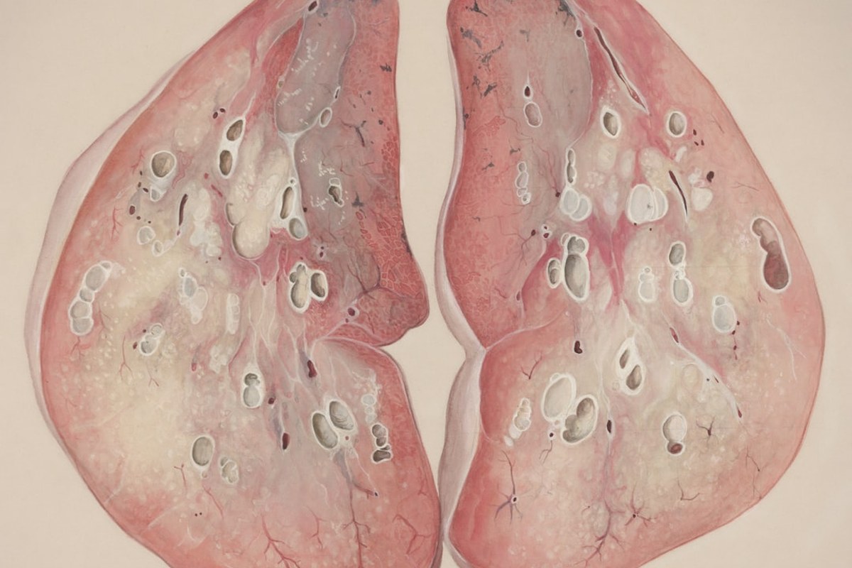 간암 치료 ‘큰 발전’ 이뤘지만 생존 열쇠는 ‘조기 발견’ - 이미지 3