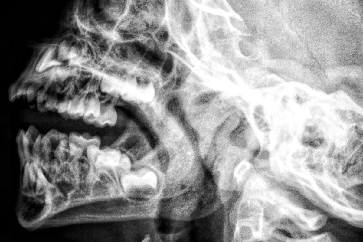 유방암 환자들, ‘증상 없어도’ 뇌 MRI 찍어야 하는 이유? - 이미지 3