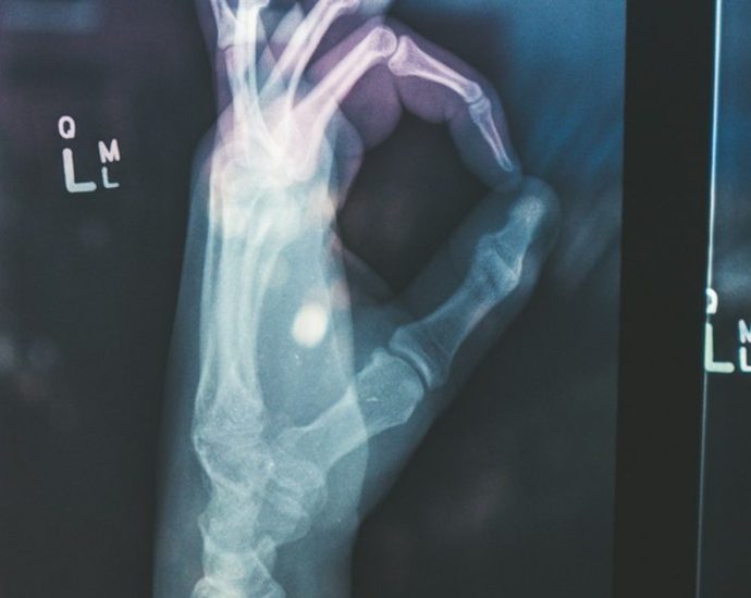 ‘노 페인 노 게인?’ 뼈 통증 참지 마요…까딱 잘못하다 피로골절