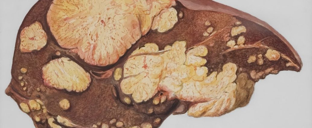 "설탕보다 췌장에 치명적" 최악 음식 4가지는?