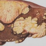 "설탕보다 췌장에 치명적" 최악 음식 4가지는?