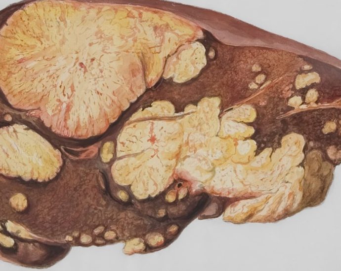 "설탕보다 췌장에 치명적" 최악 음식 4가지는?
