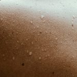 벌써 겁나는 다한증…수술만이 답일까? [건강한겨레]