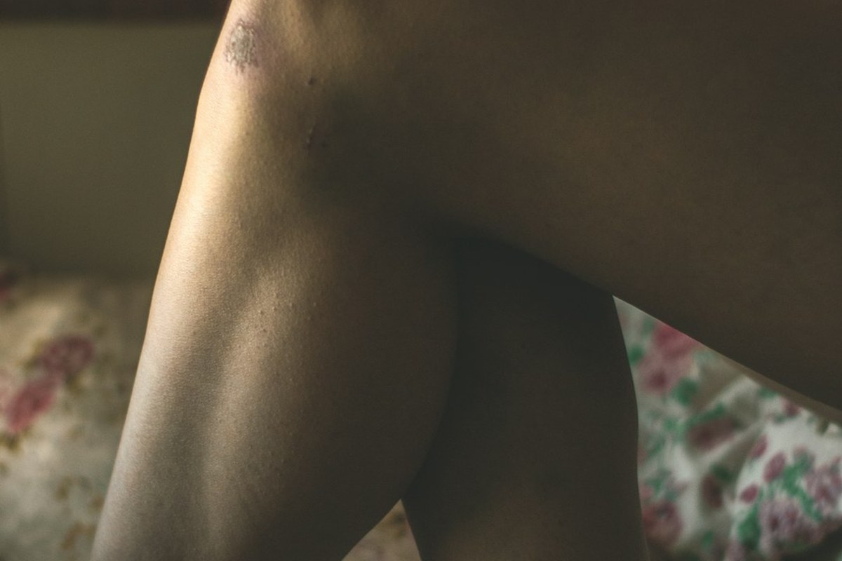 💥무릎 골절, 단순 뼈 부상? 관절 기능 지키는 초기 치료의 모든 것! ✅ - 이미지 2