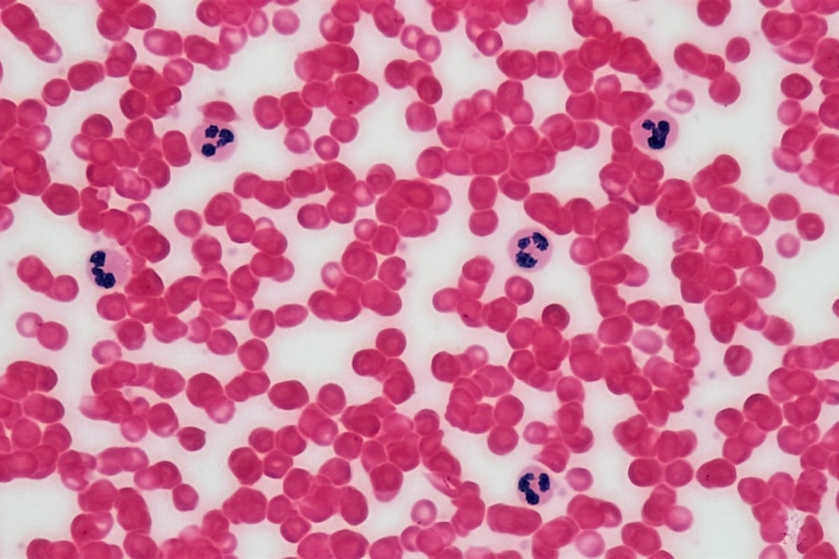 🚨 빈혈, 단순 피로 NO! 치매 위험 66% UP! 뇌 건강 적신호 💡 - 이미지 3