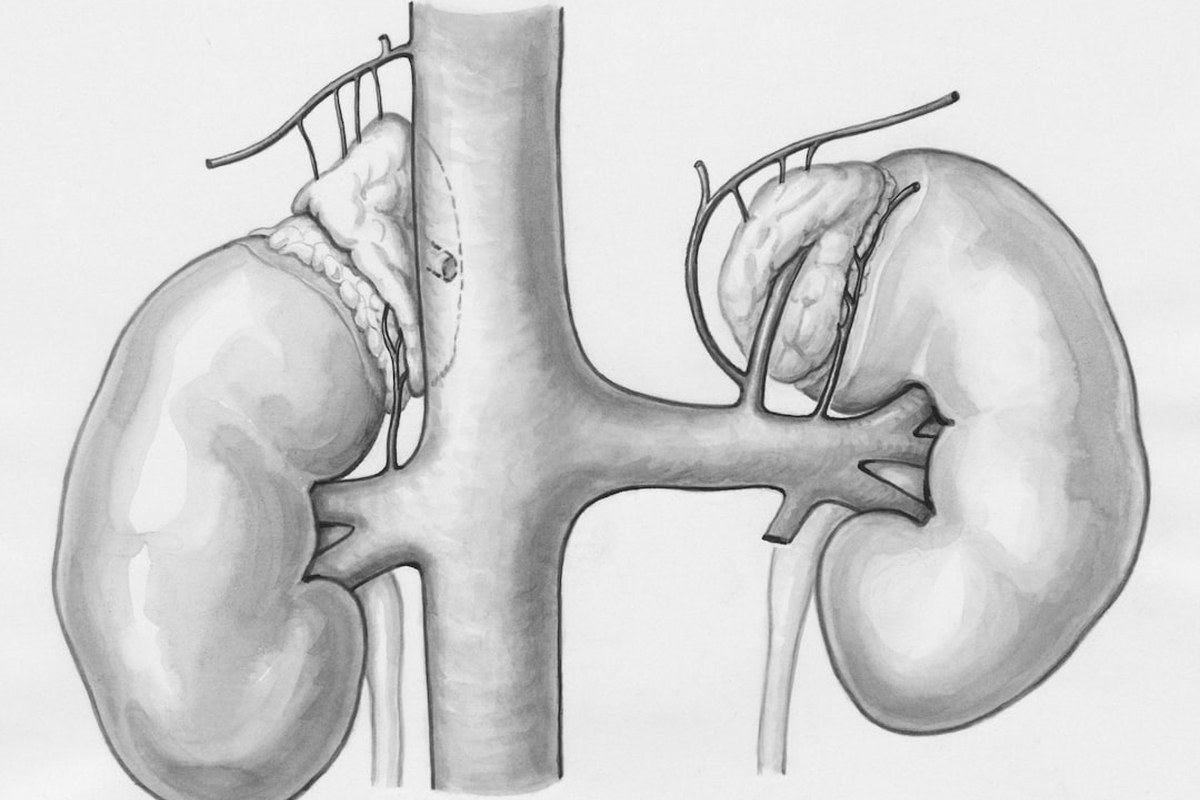 ✅ 혈액형 달라 괜찮아! 신장 이식, 희망을 잇는 '탈감작 요법'의 놀라운 진화 💡 - 이미지 3