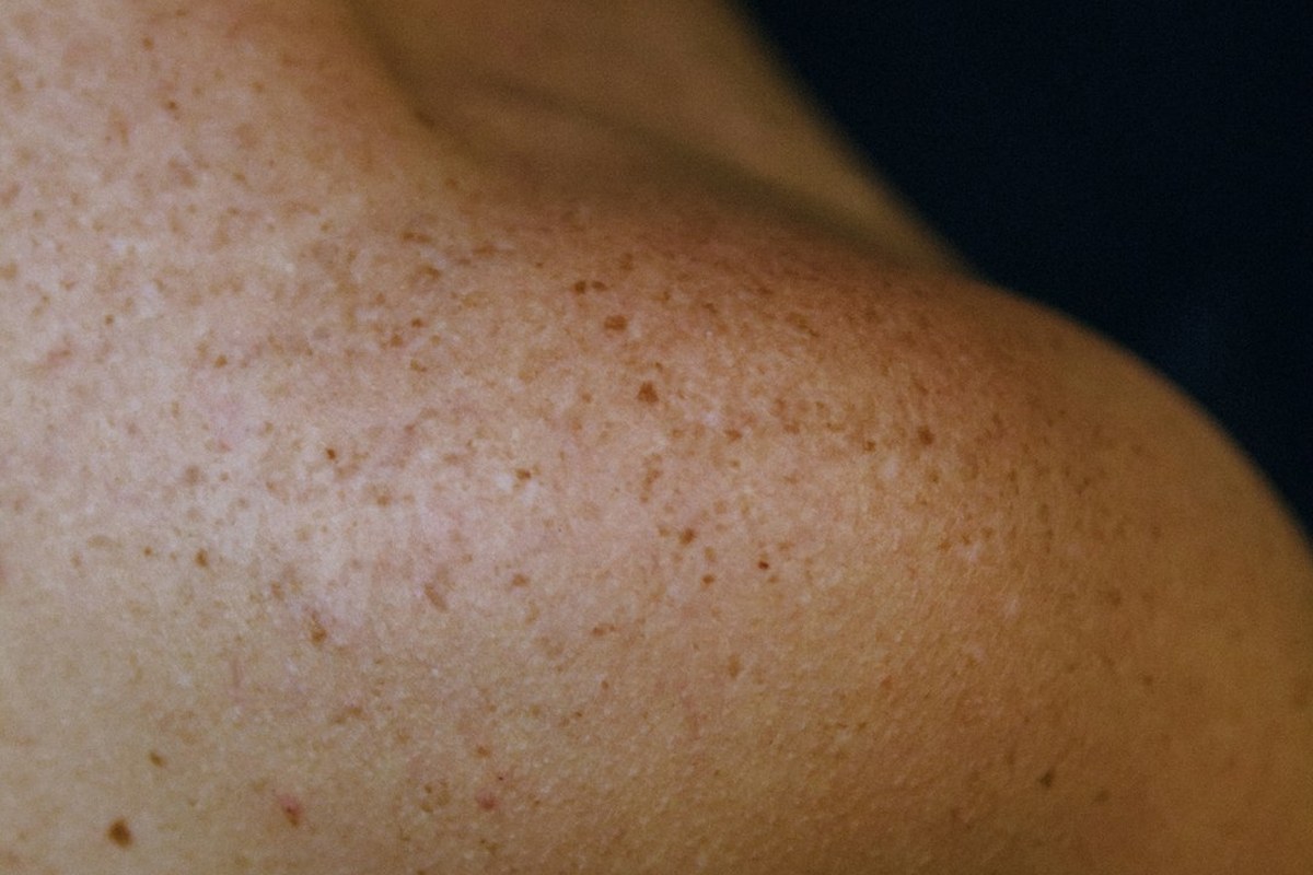 [약손+] 무심코 넘기면 위험하다 “피부암 제대로 알기” ⑬피부암 진단과 비수술적 치료 - 이미지 3