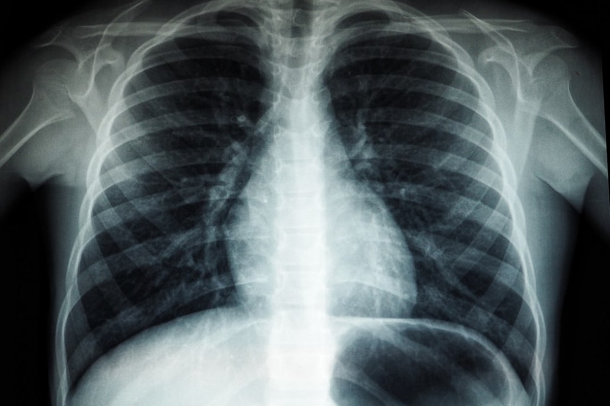 🚭️흡연자 95%가 걸리는 '소세포폐암', 치명적인 이유와 조기 발견 팁 ✅ - 이미지 4