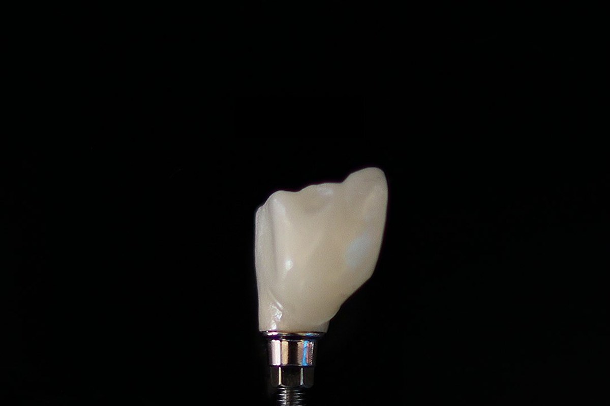 임플란트, 성패 가르는 뼈... “이것 체크하세요” - 이미지 4