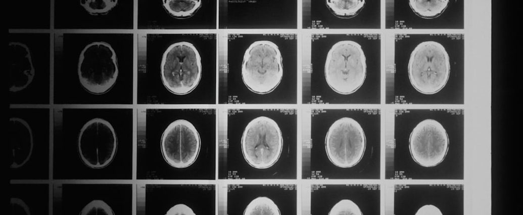 뇌종양 방사선 치료, 시력 보호 위해 줄였더니… 10년 뒤 시력 저하 위험 ↑ ✅
