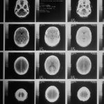 💡 뇌척수액 없이 치매 조기 진단? '미니 뇌'가 열어갈 미래!