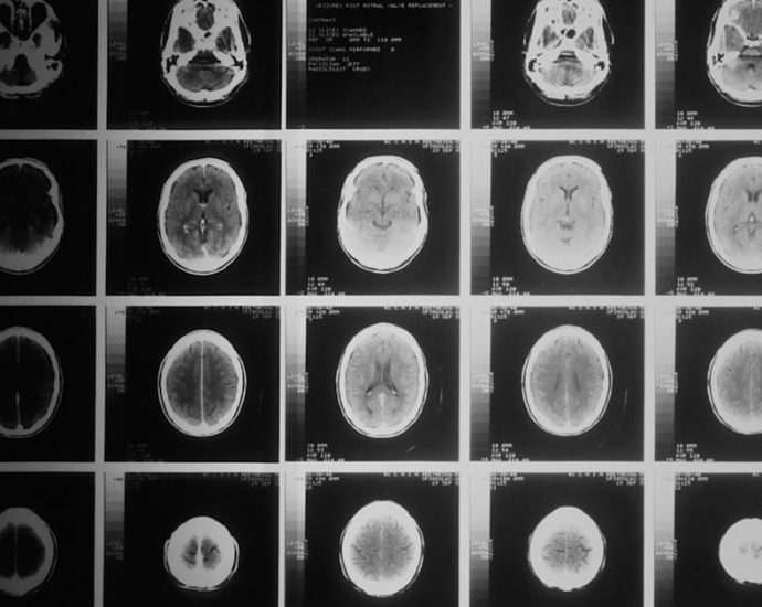 💡 뇌척수액 없이 치매 조기 진단? '미니 뇌'가 열어갈 미래!