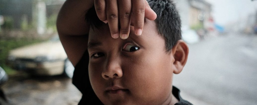 "눈에서 빛이 나요!"… 우리 아이, 안구암 망막모세포종 조기 발견의 중요성 ✅