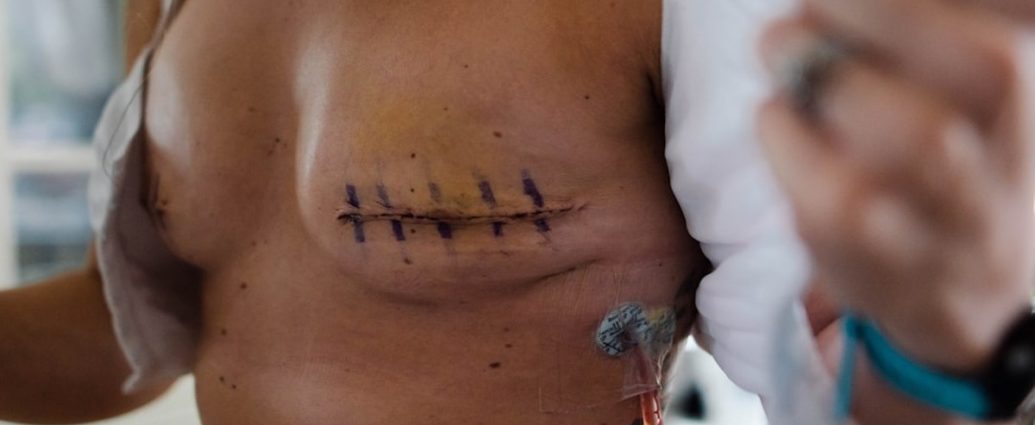 ✅ 유방암 재활, 근력보다 '움직임 조절'이 핵심! 💡 새로운 ReMAP 프로그램 효과 확인