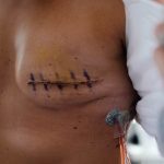 ✅ 유방암 재활, 근력보다 '움직임 조절'이 핵심! 💡 새로운 ReMAP 프로그램 효과 확인