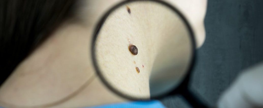 [약손+] 무심코 넘기면 위험하다 “피부암 제대로 알기” ⑬피부암 진단과 비수술적 치료