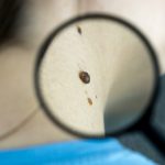 [약손+] 무심코 넘기면 위험하다 “피부암 제대로 알기” ⑬피부암 진단과 비수술적 치료