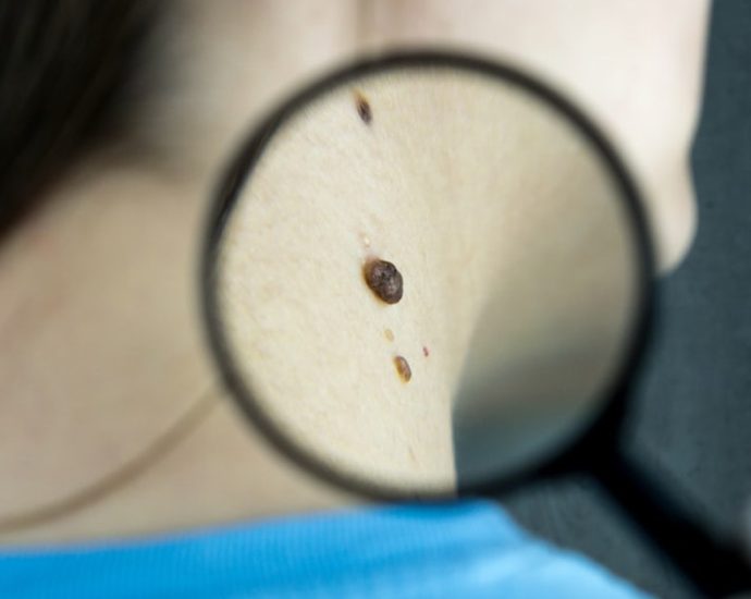 [약손+] 무심코 넘기면 위험하다 “피부암 제대로 알기” ⑬피부암 진단과 비수술적 치료