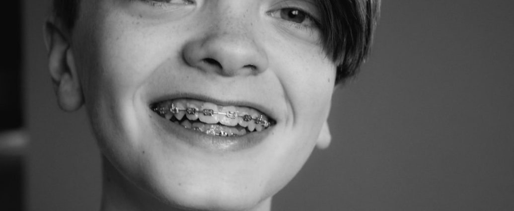 ✅ 성장기 치아교정, '언제'가 가장 중요할까? 🦷 적절한 시점 가이드