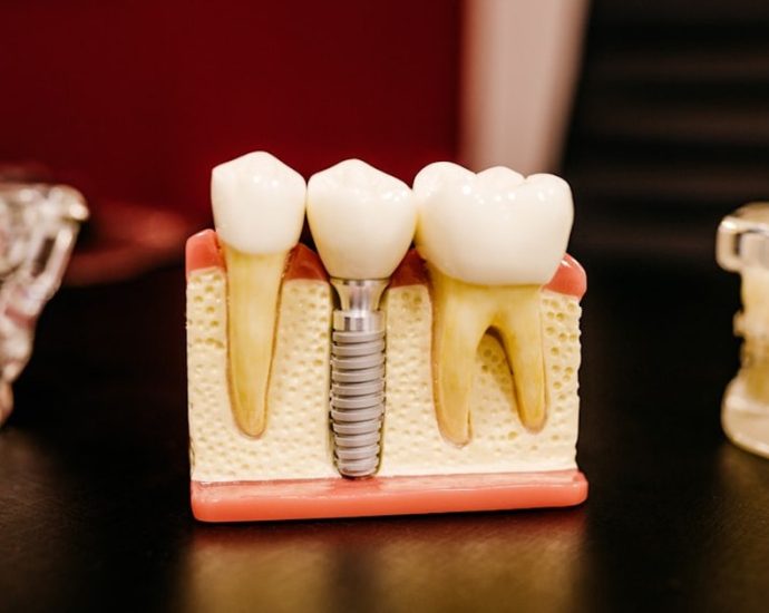 임플란트, 성패 가르는 뼈... “이것 체크하세요”