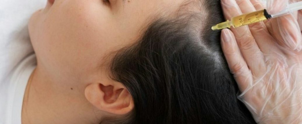 원형탈모증 치료, 중증이면 JAK 억제제부터? 미국 전문가 합의문
