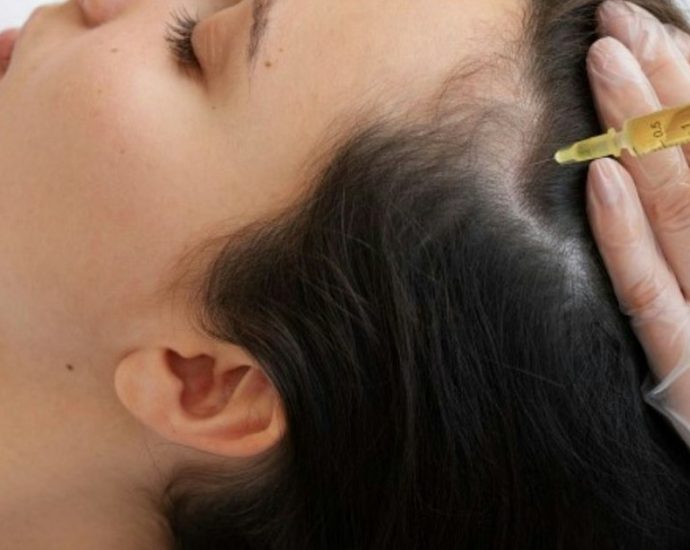 원형탈모증 치료, 중증이면 JAK 억제제부터? 미국 전문가 합의문